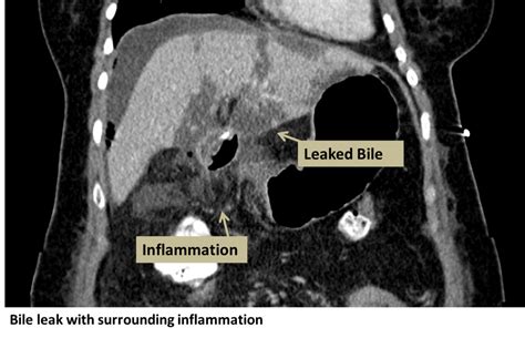 b4il3e leaks|Bile Leaks